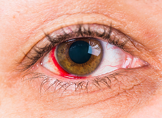 Cornea+Glue2_WS.png