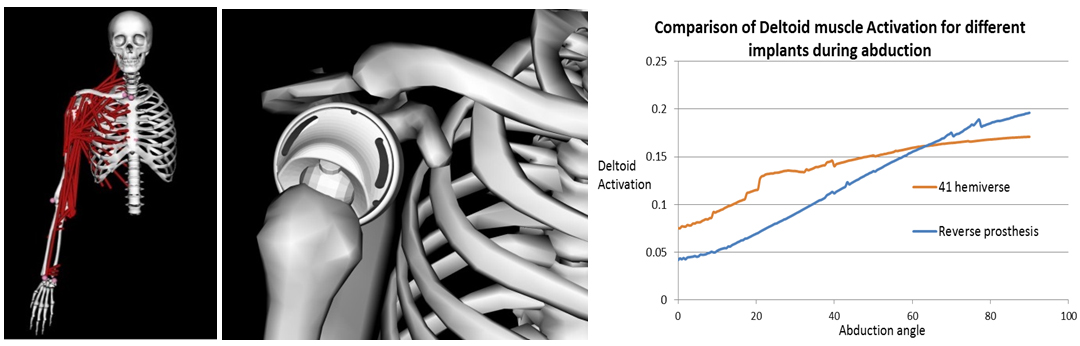 Fig+1+New+shoulder+prosthesis.jpg