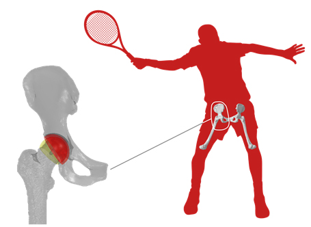 Fig+5+Resurfacing+hip+replacement.jpg