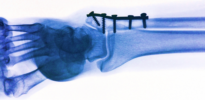 Magnesiumschraube+Stopper.jpg