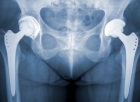 a592-2010-08-10-b0s+stopper+Implantate.jpg
