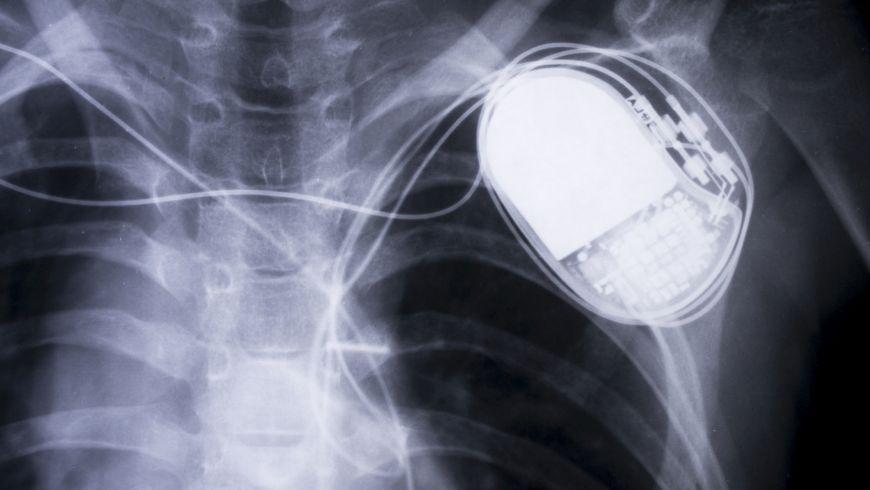 Pacemaker.jpg