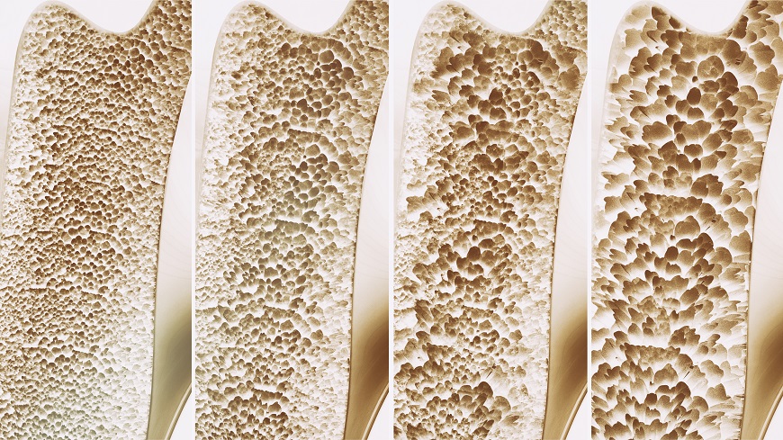 Knochen+EQ65+Stopperbild+iStock.jpg